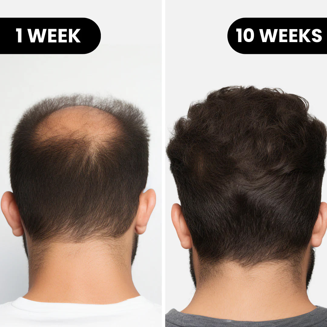 Louxlue™ Hair Regrowth System