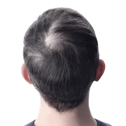 Louxlue™ Hair Regrowth System