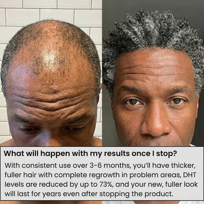 Louxlue™ Hair Regrowth System