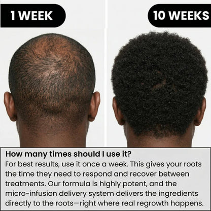 Louxlue™ Hair Regrowth System